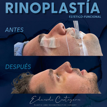Slider image (7) Dr. Eduardo Cartagena Plastic and Reconstructive Surgeon